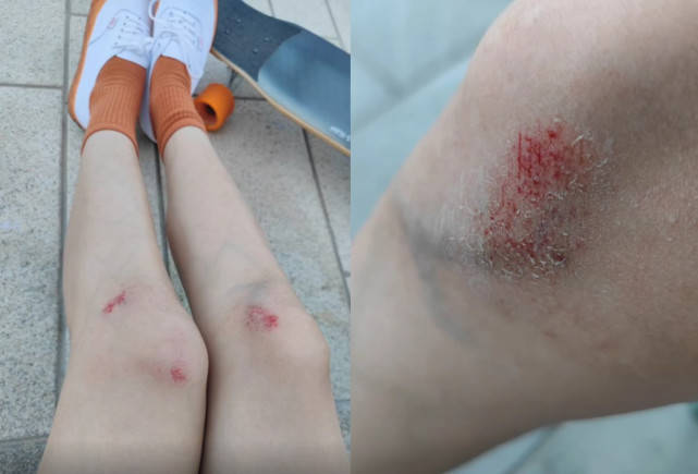 张梓琳玩滑板受伤 双腿膝盖大面积青紫令人心疼 