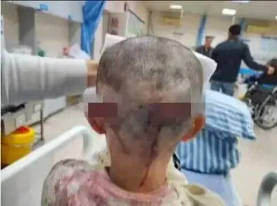 安徽7岁女童被恶犬撕咬致毁容