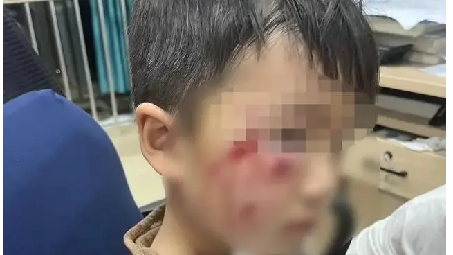 3岁男童被恶犬咬伤离世 母亲发声