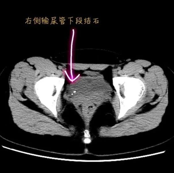 腹中剧痛3天，17岁女生还在忍着学习！拍了CT，父母瞬间傻眼...