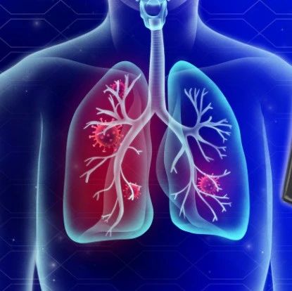 救命的人工肺（ECMO），为什么还没有国产化？