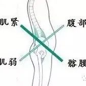 【运动康复】 下交叉综合征（4）