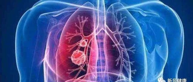查出两肺布满结节，意味着癌变前兆吗？是切还是留？【新民健康】