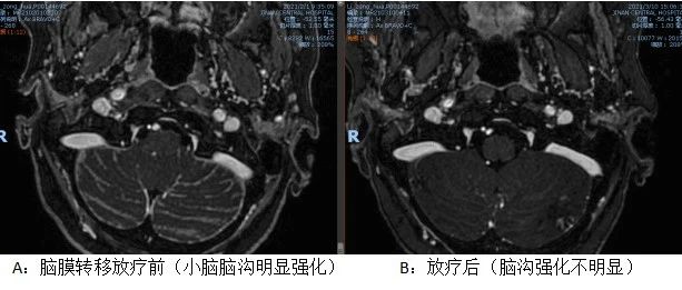 附院在线 | 山一大附属中心医院放疗联合靶向治疗为脑膜转移患者带来福音