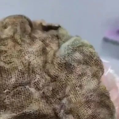 女子产后体内遗留纱布，南昌卫健委通报